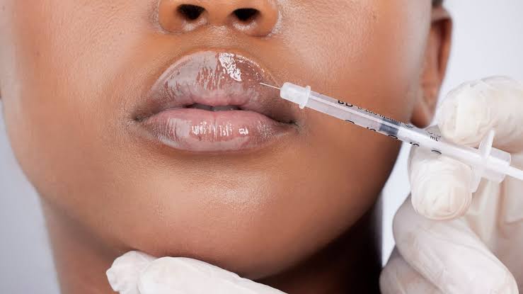 Lip filler procedure